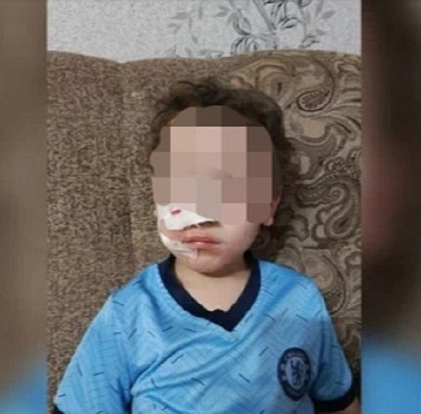 За нападение бездомной собаки на ребёнка в Яранске ответят чиновники из управления ветеринарии